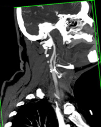 Stenosis of Right Carotid - CTisus CT Scan