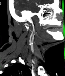 Occlusion of Left Internal Carotid - CTisus CT Scan