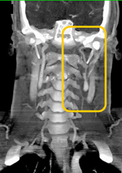 Artifacts Beyond Head and Neck - CTisus CT Scan