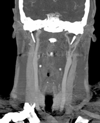 Artifact Due to Swallowing But Injury to Left Carotid Artery - CTisus CT Scan