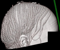 Nice BrAIDS - CTisus CT Scan