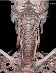 Carotid Artery Stenosis With Plaque - CTisus CT Scan