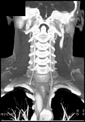 Vertebral Arteries - CTisus CT Scan