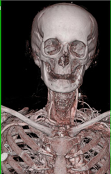 Nice Range of Renderings From Bone to Skin to Vessel - CTisus CT Scan