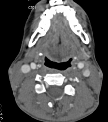 Normal Neck Vessels - CTisus CT Scan