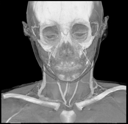 Normal Venous Anatomy - CTisus CT Scan