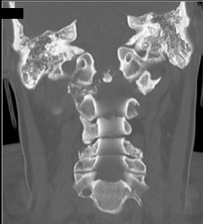 C-2 Fractures - CTisus CT Scan