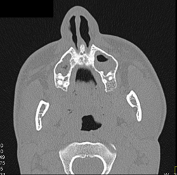 Orbital Trauma - CTisus CT Scan