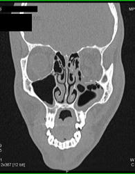 Orbital Trauma - CTisus CT Scan