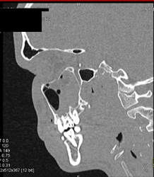 Orbital Trauma - CTisus CT Scan