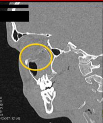 Orbital Trauma - CTisus CT Scan