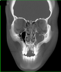 Orbital Trauma - CTisus CT Scan