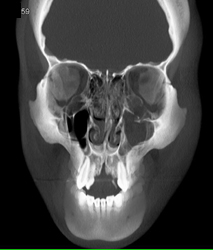 Orbital Trauma - CTisus CT Scan