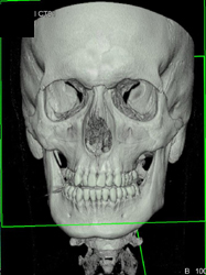 Orbital Trauma - CTisus CT Scan