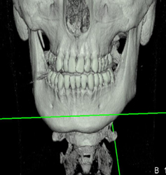 Orbital Trauma - CTisus CT Scan