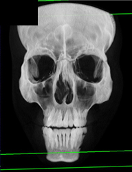 Orbital Trauma - CTisus CT Scan