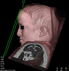 Loeys-Dietz Syndrome With Ectatic Carotid Arteries - CTisus CT Scan