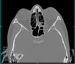 Sinusitis - CTisus CT Scan