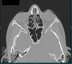 Sinusitis - CTisus CT Scan