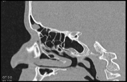 Sinusitis - CTisus CT Scan