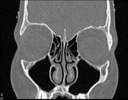 Sinusitis - CTisus CT Scan