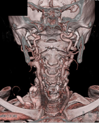 Ectatic Carotids in Loeys-Dietz - CTisus CT Scan