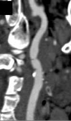 Carotid Stenosis - CTisus CT Scan