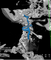 Carotid Stenosis - CTisus CT Scan