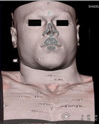 GSW to Chest - CTisus CT Scan