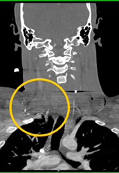 Injury to Carotid Artery - CTisus CT Scan