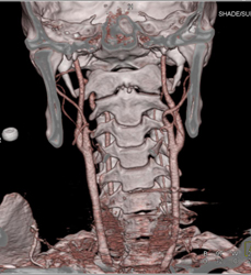 Normal Carotid Artery - CTisus CT Scan