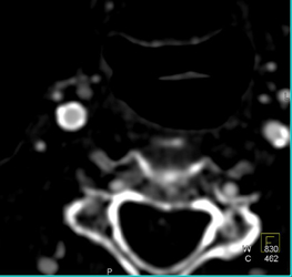 Stent in Carotid Artery - CTisus CT Scan