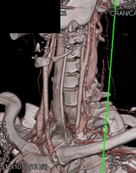 Narrow Proximal Carotid Artery-S/P Gun Shot Wound - CTisus CT Scan