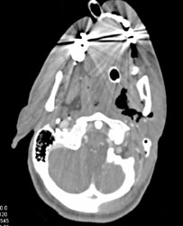 Trauma to Neck - CTisus CT Scan