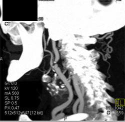 Occlusion Right Internal Carotid Artery Origin With Different Renderings - CTisus CT Scan