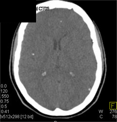 Cysticercosis - CTisus CT Scan