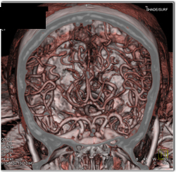 Normal Intracranial Circulation in 3D - CTisus CT Scan