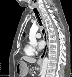 Airway Stenosis - CTisus CT Scan