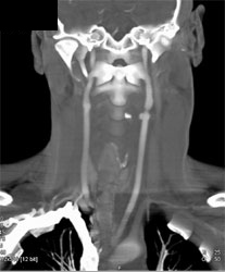 Laceration Left Carotid Artery - CTisus CT Scan