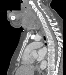 Laryngeal Cancer With Tracheostomy Tube - CTisus CT Scan