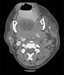 Tumor Encases Carotid Artery and Occludesleft Jugular Vein - CTisus CT Scan