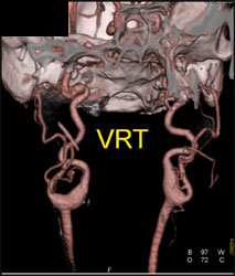 Loeys-Dietz - CTisus CT Scan