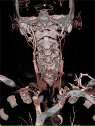 Carotid Artery Stenosis With Various Renderings - CTisus CT Scan