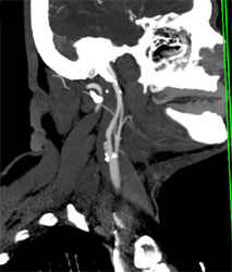 3D of Mandible Without Teeth - CTisus CT Scan