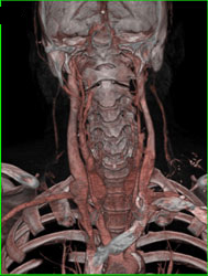 Right Sided Infarct With 3D CTA - CTisus CT Scan