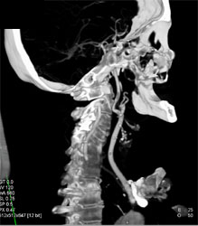 Carotid Stenosis - CTisus CT Scan