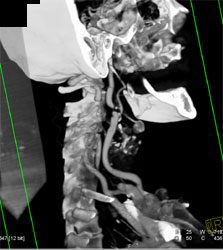 Carotid Stenosis - CTisus CT Scan