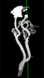 Carotid Stenosis - CTisus CT Scan