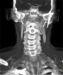 Carotid Stenosis - CTisus CT Scan