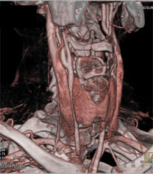 Carotid Stenosis - CTisus CT Scan